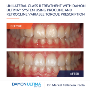 Unilateral Class II treatment with Damon Ultima™ System using procline and retrocline variable torque prescription
